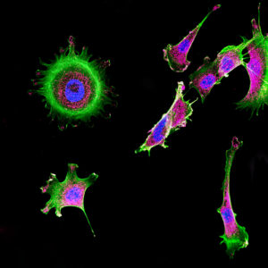 Immunofluorescence of multiple tumor cells grown in tissue culture for cancer research and visualized via confocal microscopy